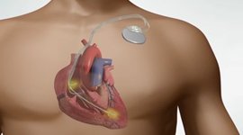 aicd-implantation-moradabad