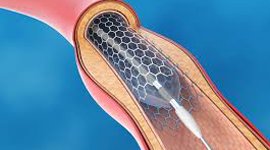 cardiac-catheterization-moradabad